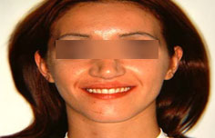 After image