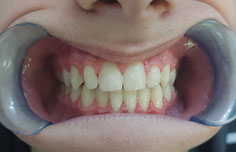 After image