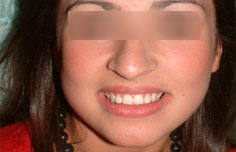 After image
